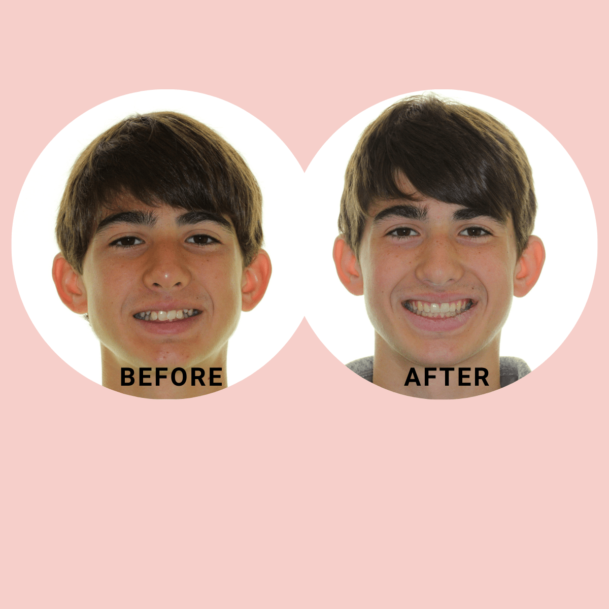 Teen Before and After Braces