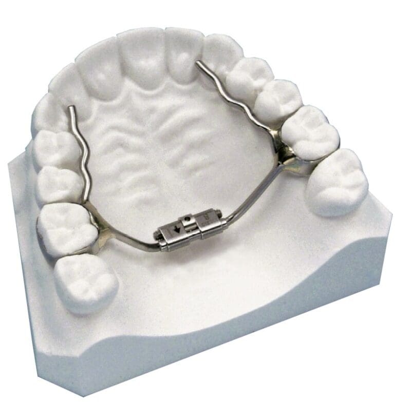 Rapid Palate Expander Appliance Phase 1